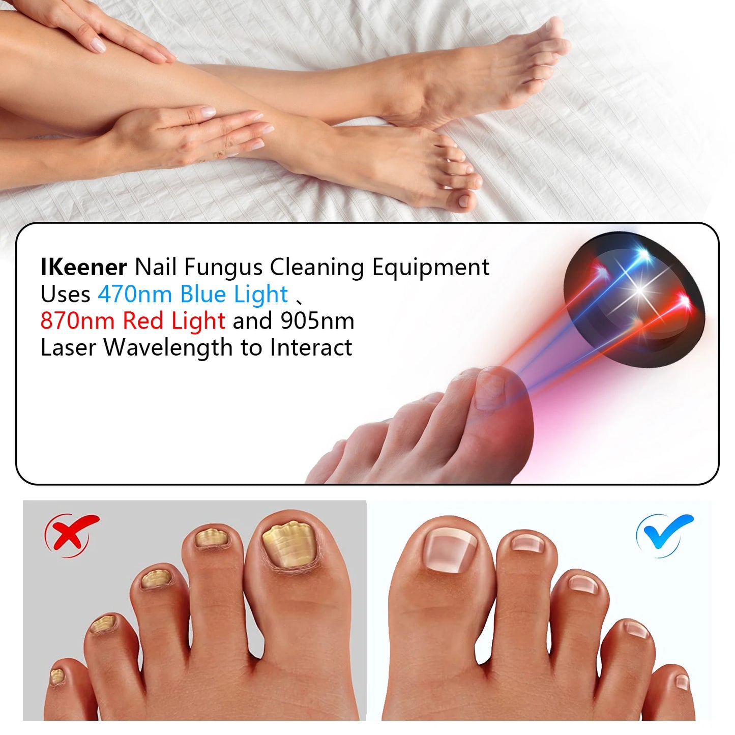The Anti-Fungal Toenail Laser Therapy Machine with USB Charge - Homevalley.co.uk